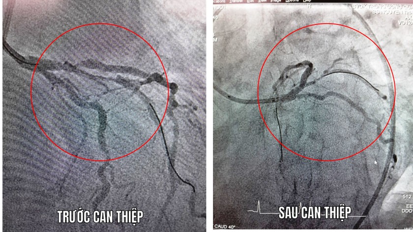 Quảng Nam: Cứu sống thành công cụ bà 77 tuổi ngừng tim do nhồi máu cơ tim