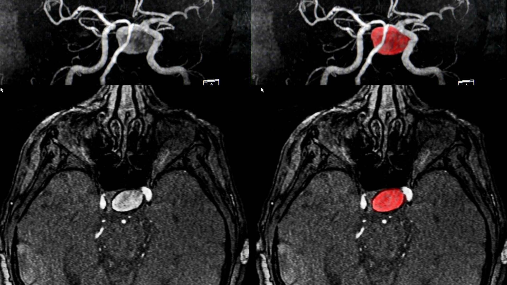 Phình mạch máu não: “Quả bom nổ chậm” trong não có gây đột quỵ?