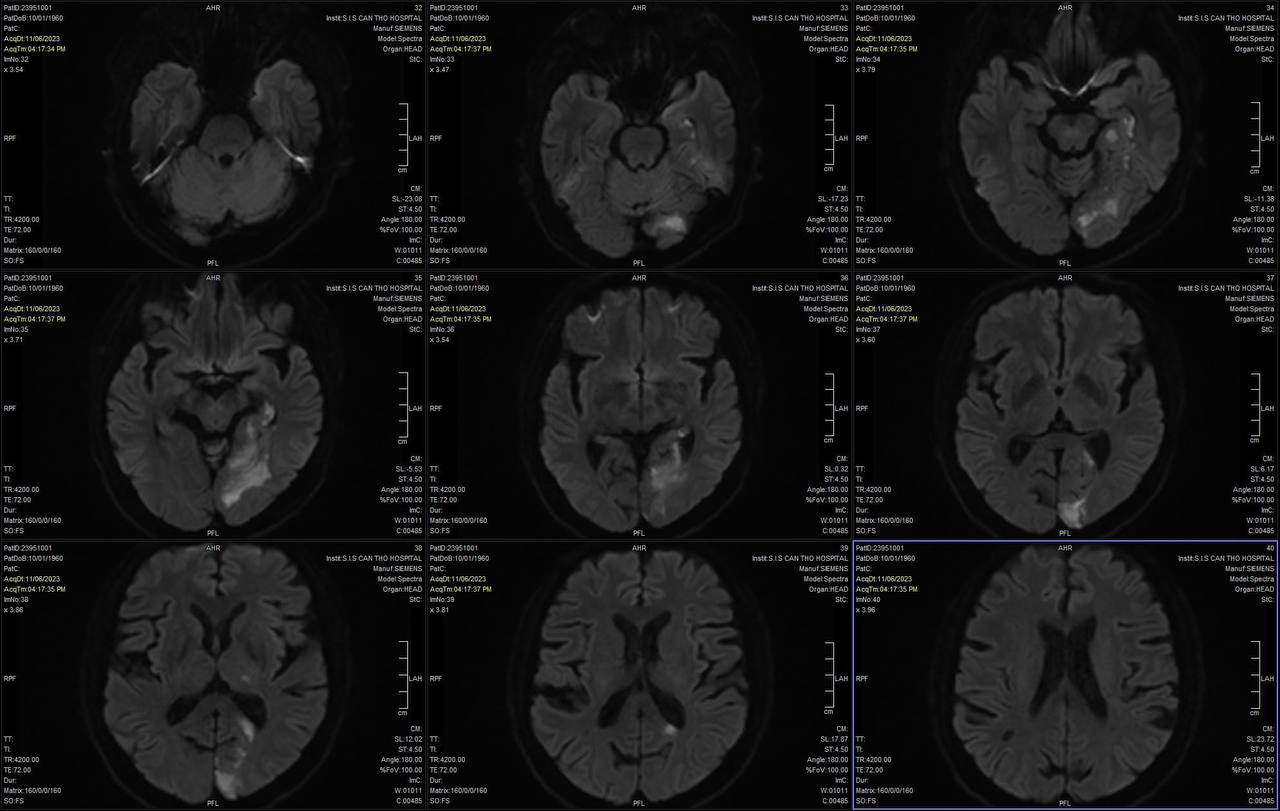 Cảnh giác với nhồi máu não thị giác khi có triệu chứng mờ mắt