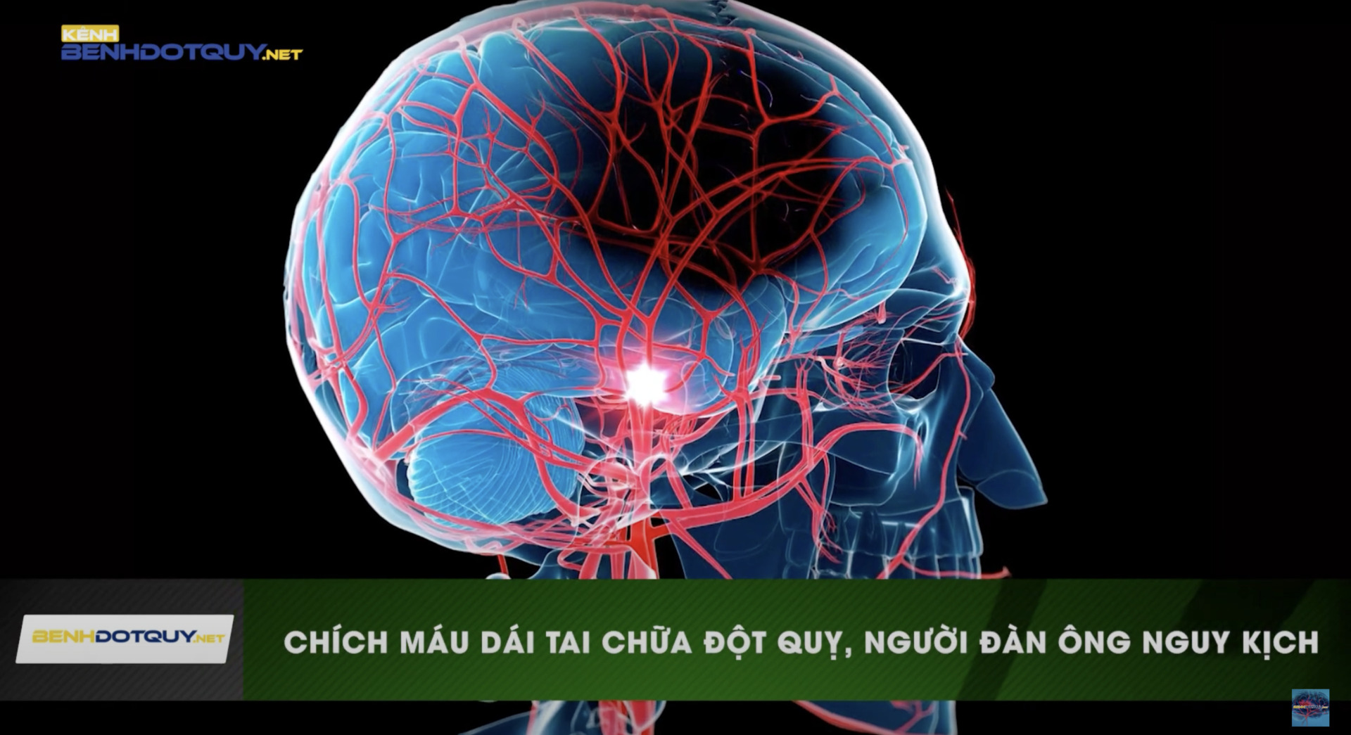 Chích máu dái tai chữa đột quỵ, người đàn ông nguy kịch