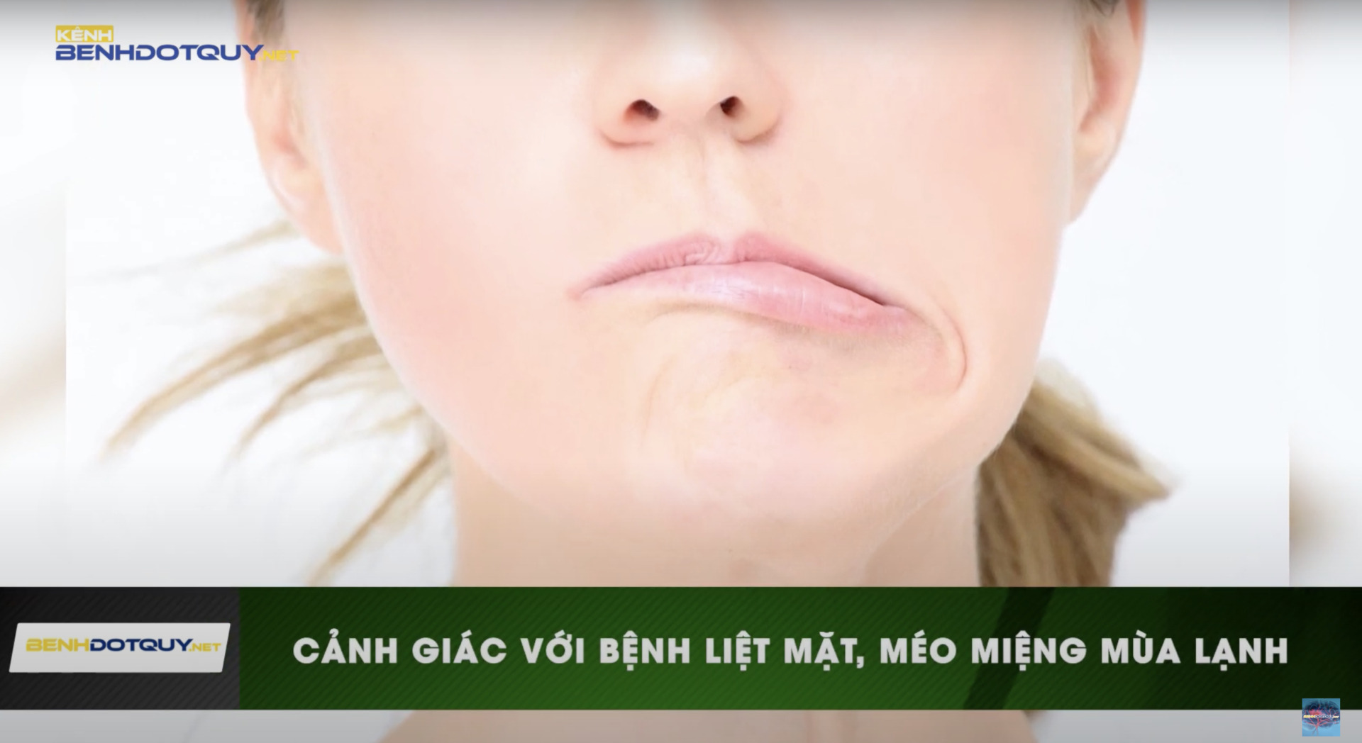 Mùa lạnh: Cảnh giác với bệnh liệt mặt, méo miệng