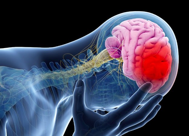 Sau xuất huyết não làm thế nào để khắc phục tình trạng tê liệt nửa người