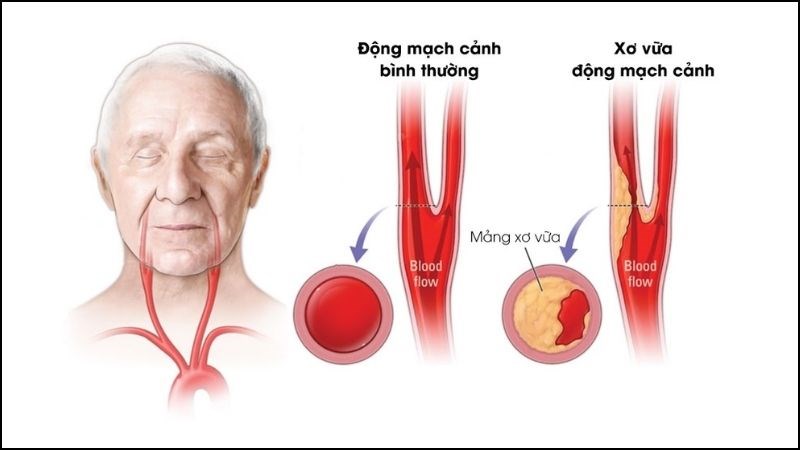 Động mạch cảnh hẹp dưới 50%, điều trị thế nào để giảm nguy cơ đột quỵ?
