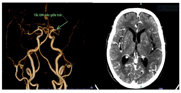 Phú Thọ: Cụ bà 92 tuổi thoát khỏi di chứng của đột quỵ nhờ được can thiệp mạch máu não kịp thời