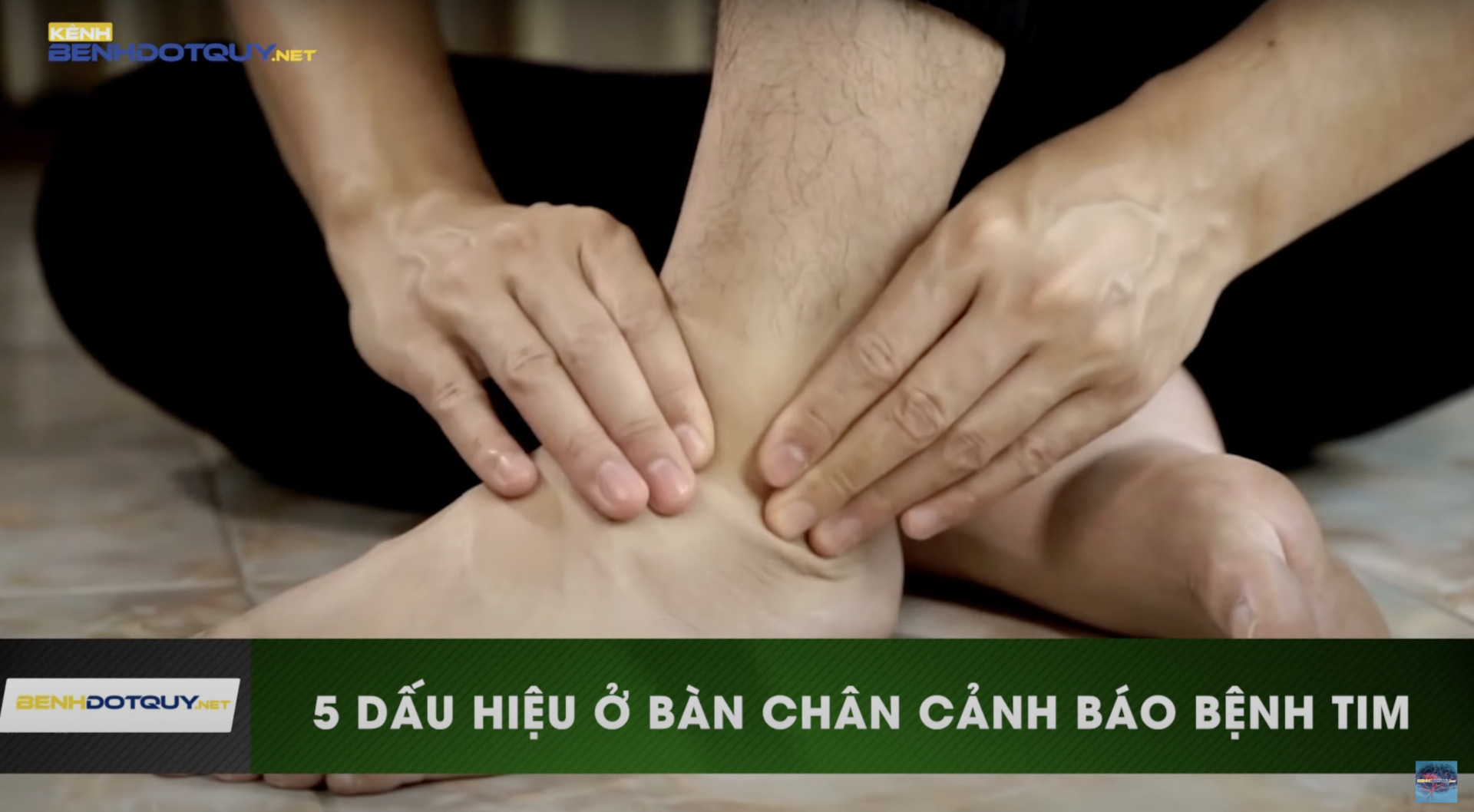 5 dấu hiệu ở bàn chân cảnh báo bệnh tim