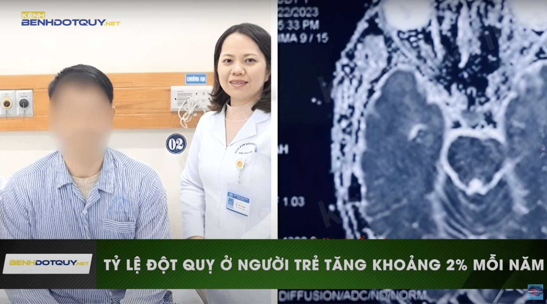 Gia tăng tỷ lệ đột quỵ ở người trẻ mỗi năm khoảng 2%