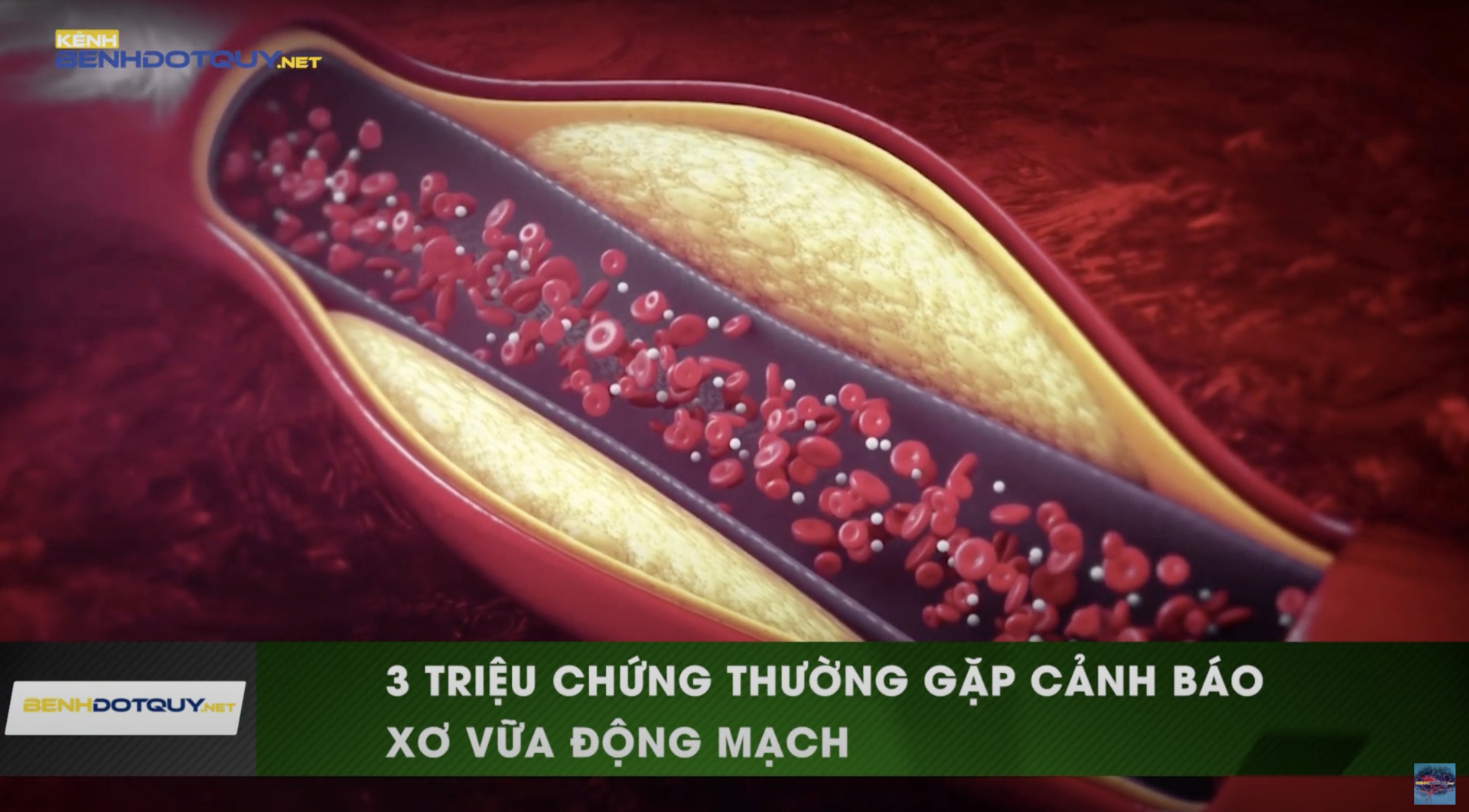 Cảnh báo xơ vữa động mạch qua 3 triệu chứng thường gặp