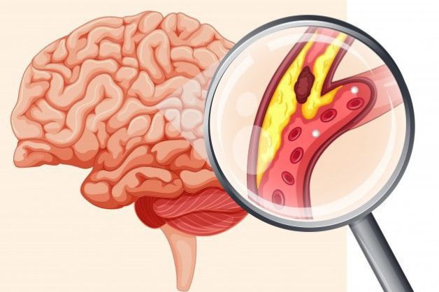 Phình mạch máu não: Nguyên nhân do đâu?