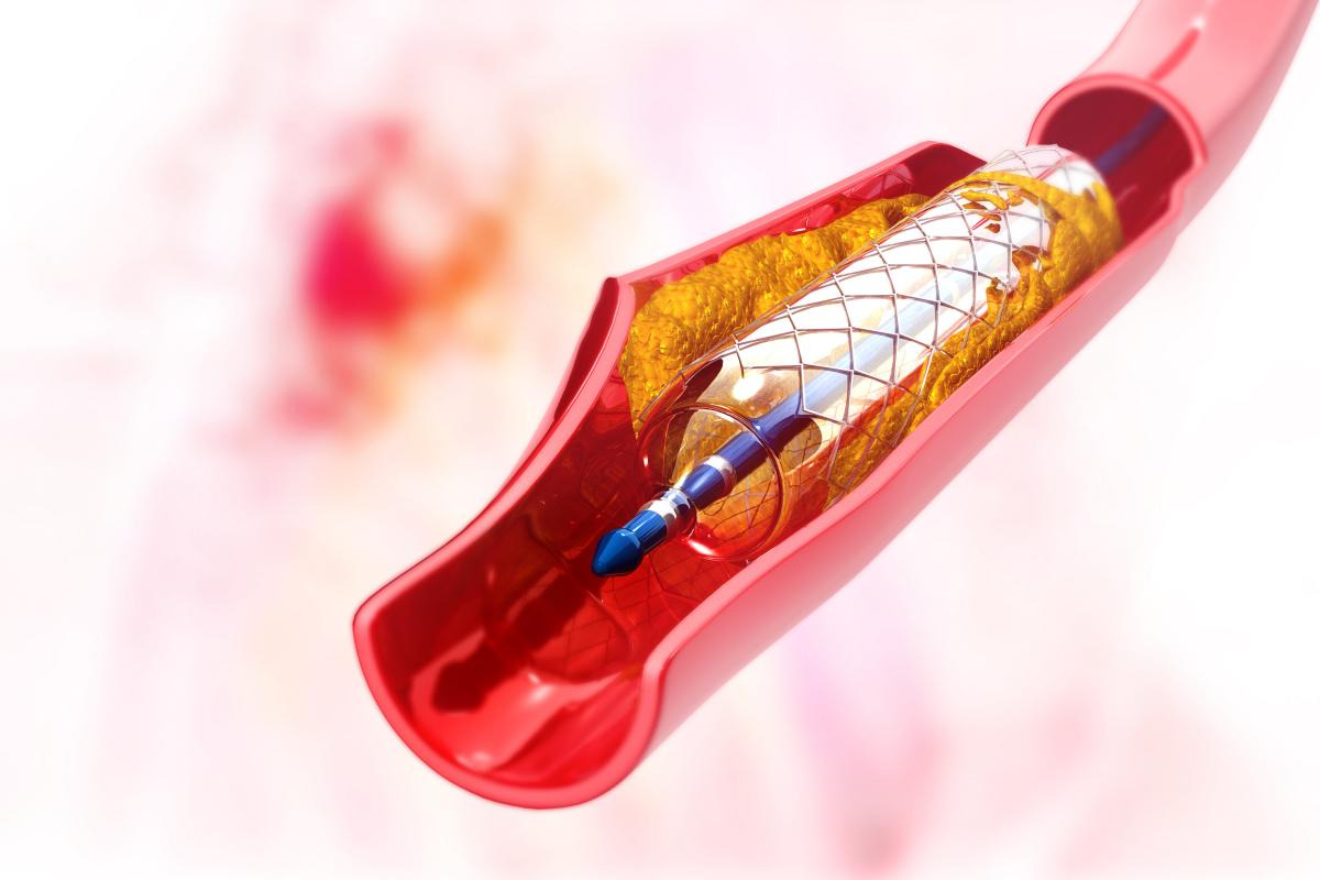Vì sao luôn cảm thấy mệt mỏi khó thở khi đã đặt stent mạch vành?