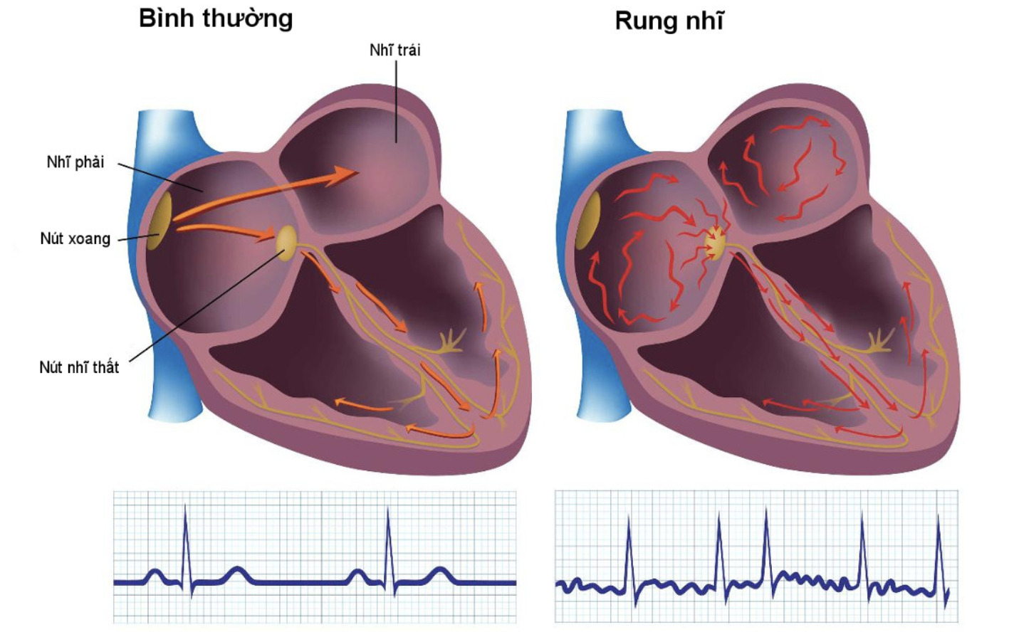 Tình trạng rung nhĩ ở người lớn có nguy hiểm không?