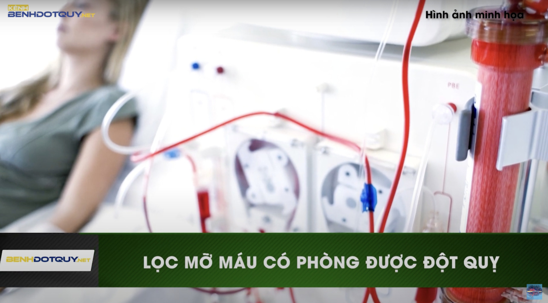 Thực hư lọc máu giúp phòng ngừa đột quỵ?
