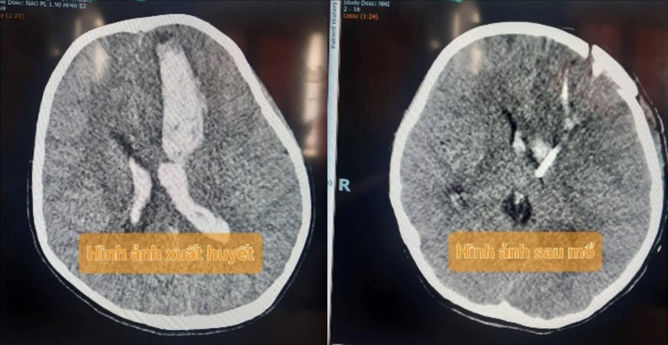 Quảng Bình: Điều trị thành công 3 bệnh nhi xuất huyết não do vỡ mạch máu