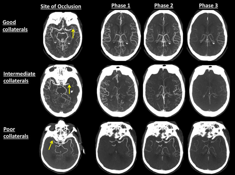 Đau nửa dầu, chụp CTscan có phát hiện được nguyên nhân không?