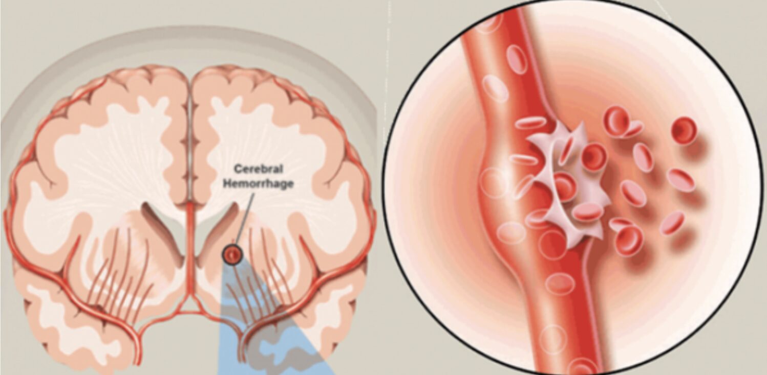 Sau cơn đột quỵ xuất huyết não, bệnh nhân liệu có khả năng phục hồi lại như bình thường?