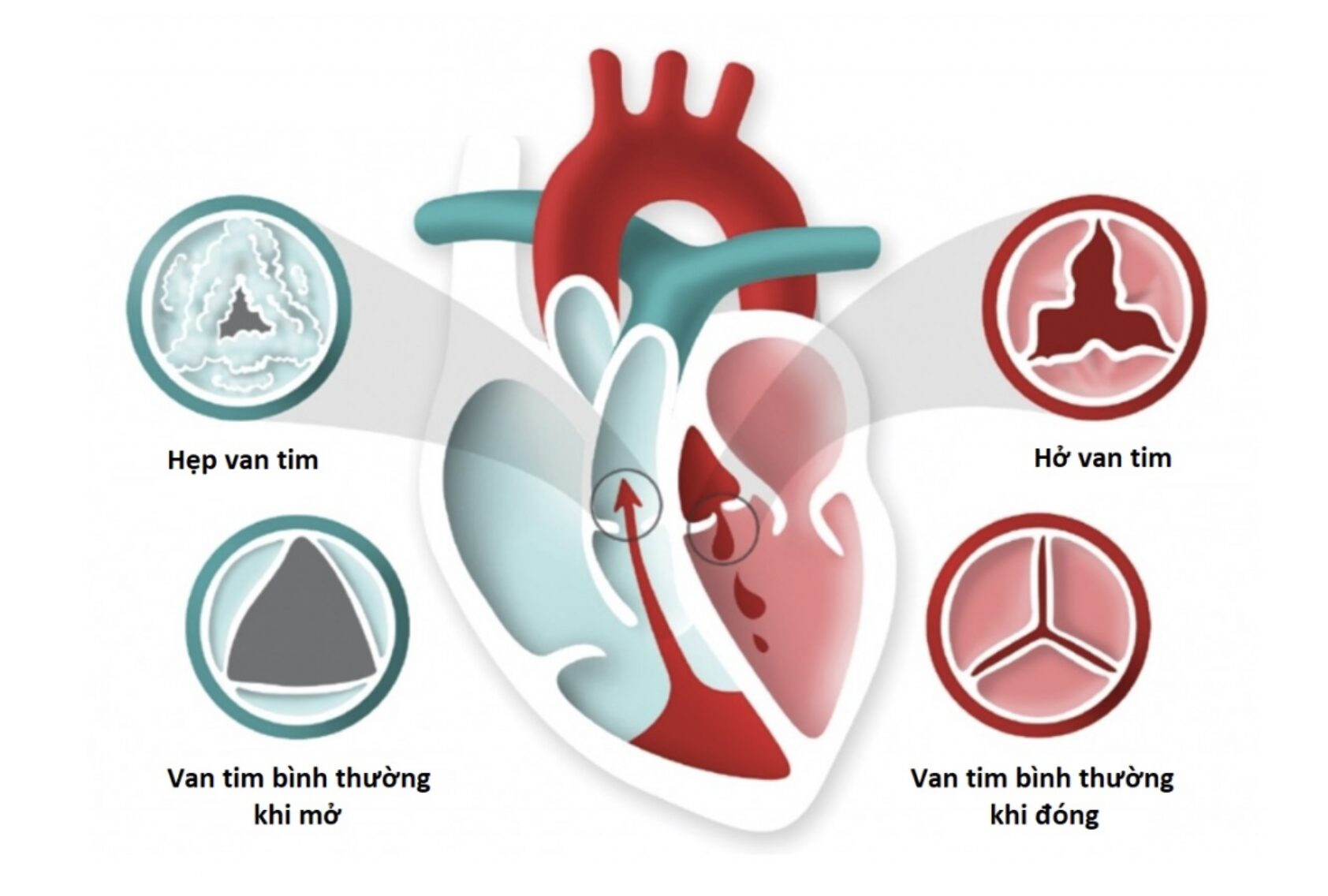 Hở van động mạch chủ có nguy hiểm không?