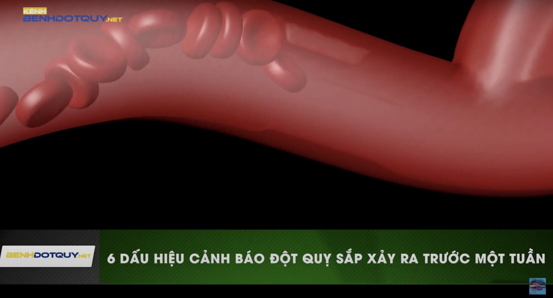 Nhận biết sớm đột quỵ qua 6 dấu hiện cảnh báo xảy ra trước một tuần