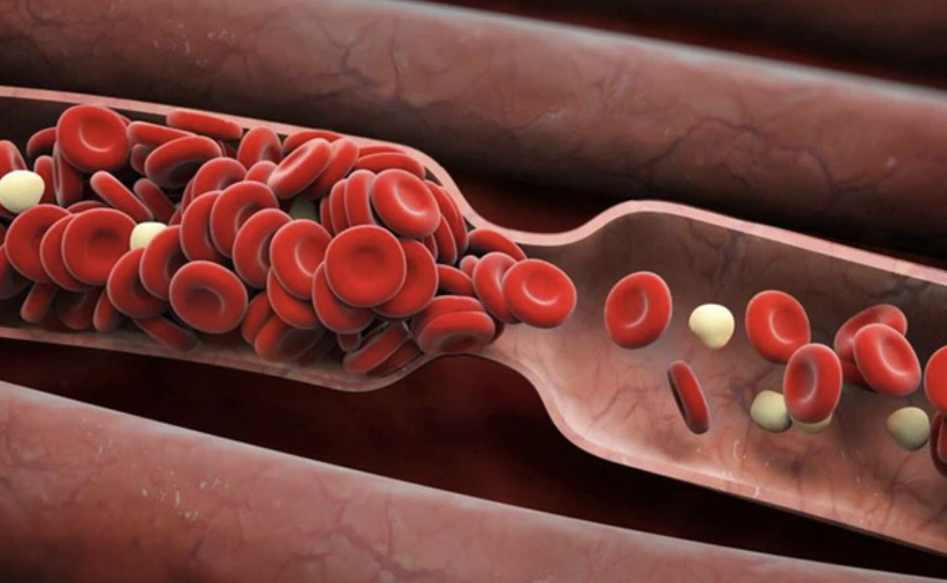 Tiềm ẩn nguy cơ đột quỵ, nhồi máu cơ tim do cục máu đông hình thành trong tim