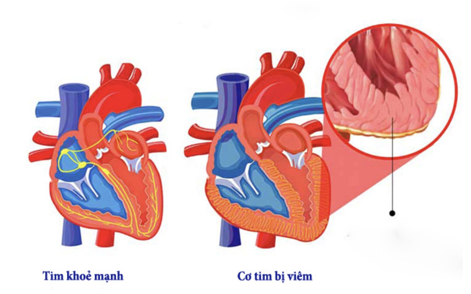 Đồng Nai: Nam bệnh nhân có nhịp tim lên đến 200 lần/ phút được cấp cứu kịp thời