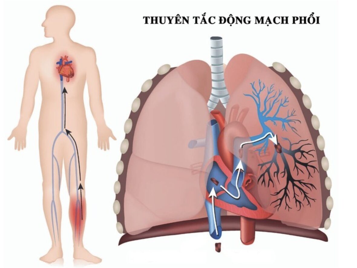 Quảng Ninh: Liên tiếp cấp cứu cho bệnh nhân suýt đột tử do thuyên tắc phổi