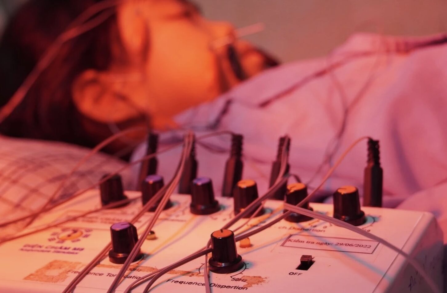 Phú Thọ: Bé gái 8 tuổi bất ngờ méo miệng do liệt mặt ngoại biên bên phải