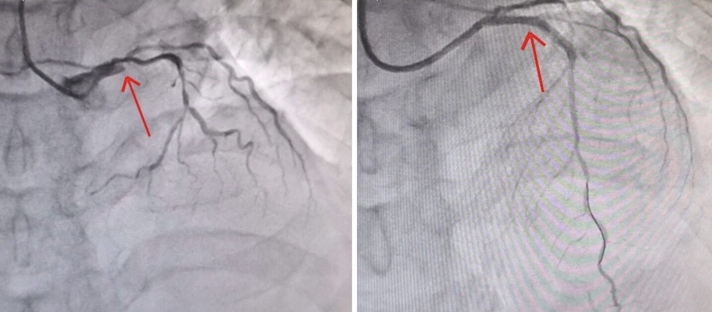 Quảng Ninh: Sau cơn đau ngực dữ dội, người đàn ông bất ngờ ngừng tuần hoàn