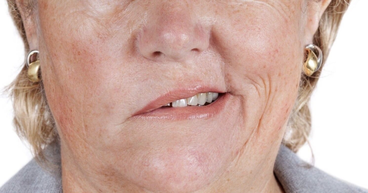 Giật một bên cơ mặt là biểu hiện của bệnh lý gì?