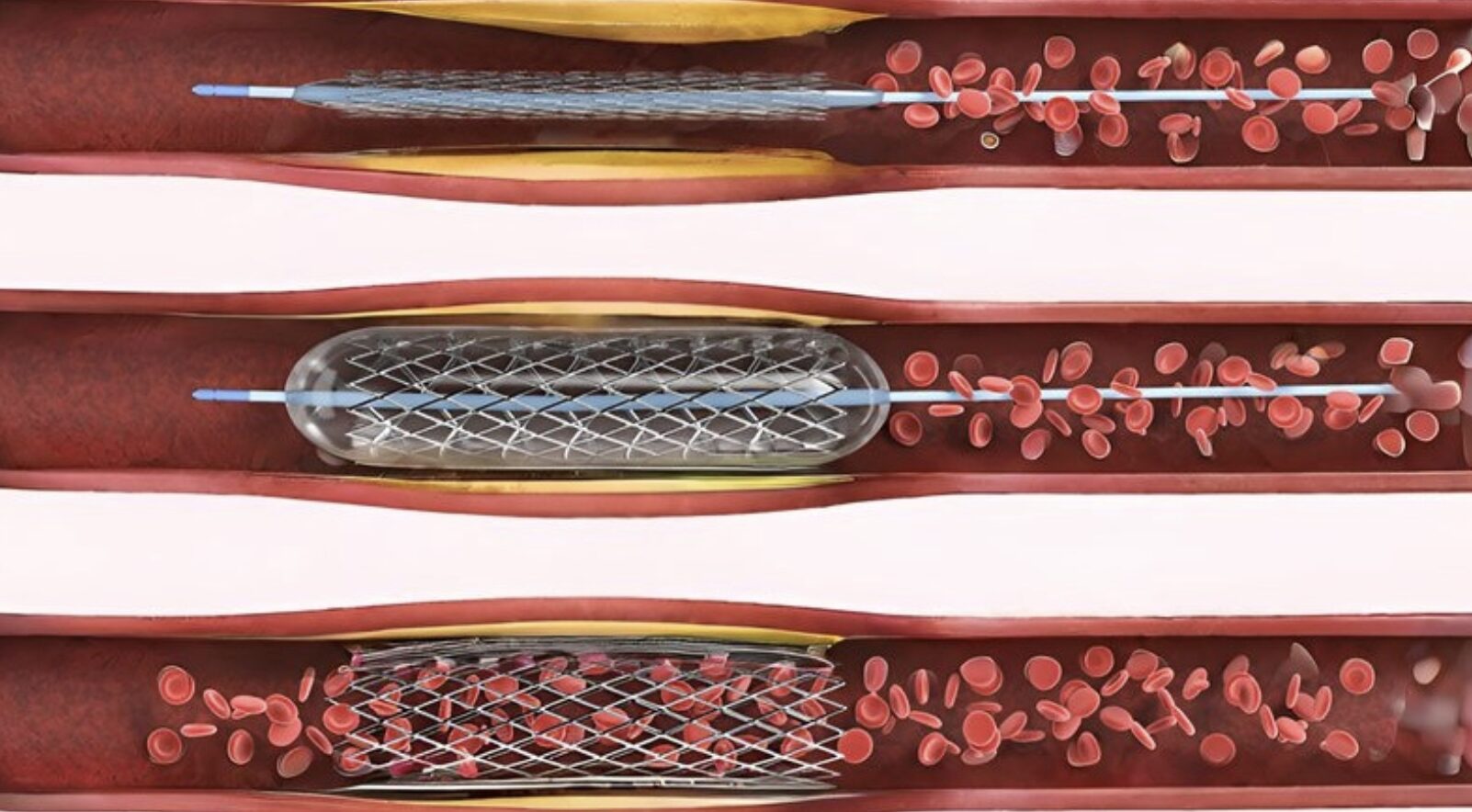Tổng chi phí đặt stent động mạch vành hiện nay là bao nhiêu?