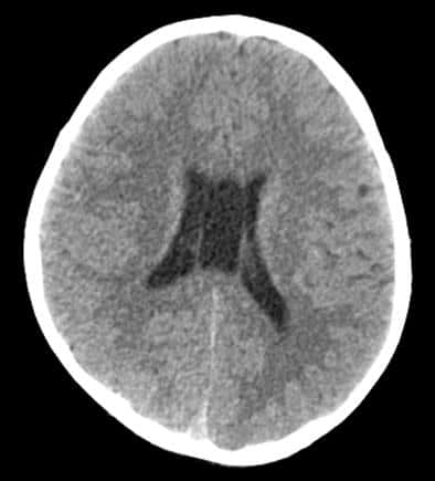 Xuất hiện nang vách ở não, có nguy hiểm không?