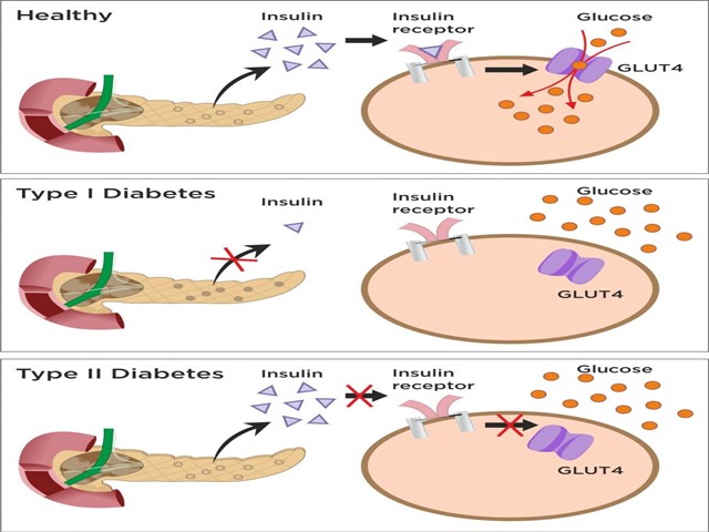Đái tháo đường type 1 và type 2 khác nhau như thế nào?