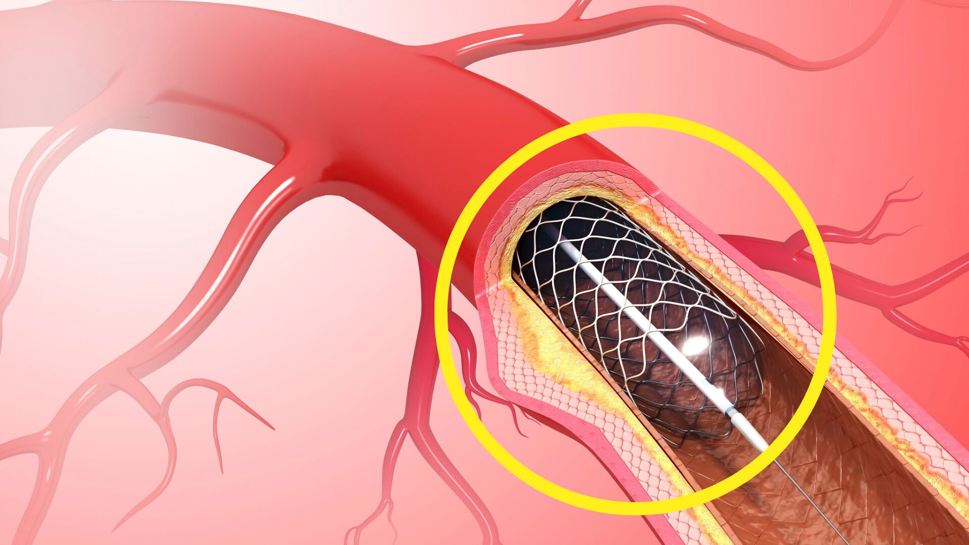 Đặt stent mạch vành chi phí bao nhiêu?