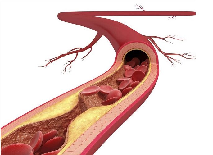 Mạch vành bị hẹp 35%, liệu có đáng lo?