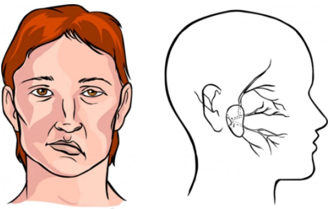Dây thần kinh số VII bị liệt, sau 38 năm có điều trị phục hồi được không?