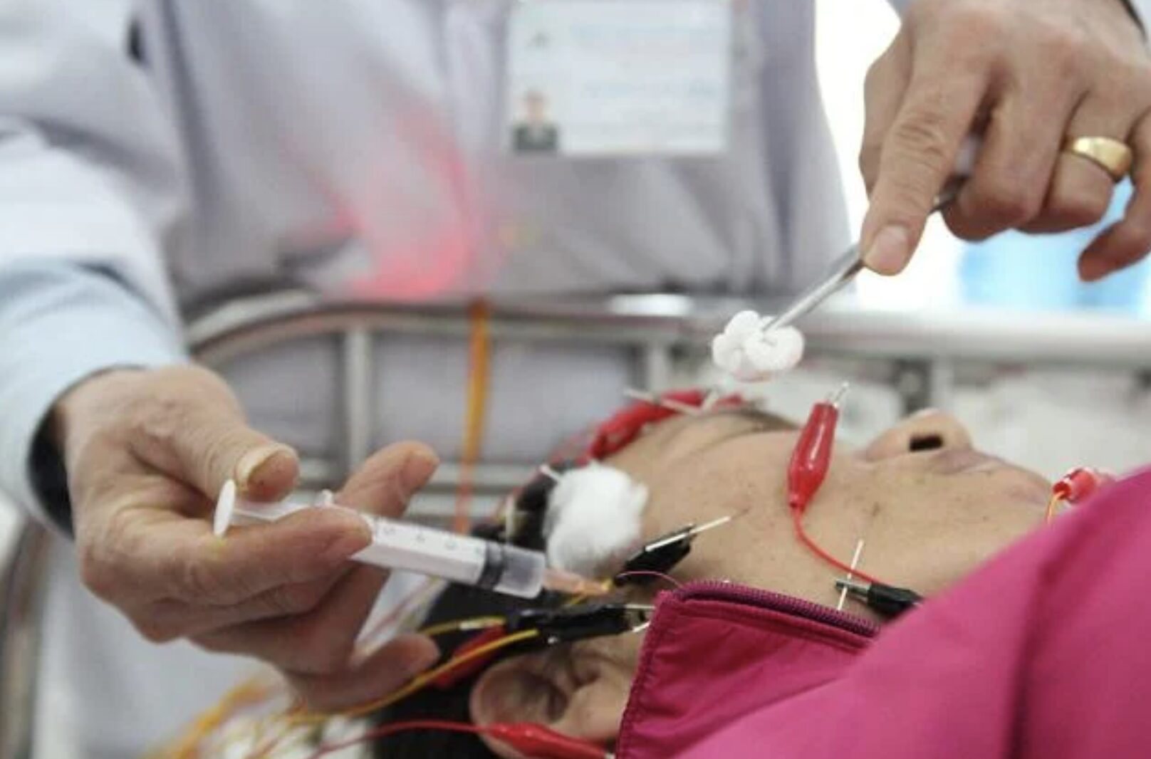 Điều trị méo miệng, nói khó bằng cách nào?