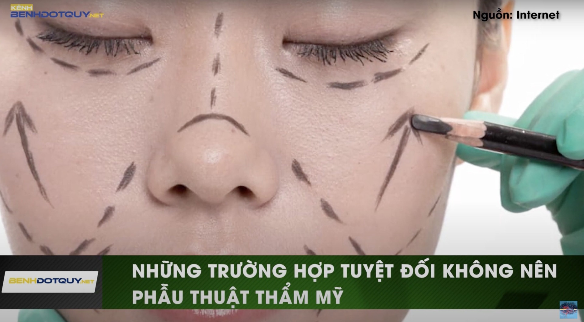 Chuyên gia cảnh báo những trường hợp không nên phẫu thuật thẩm mỹ
