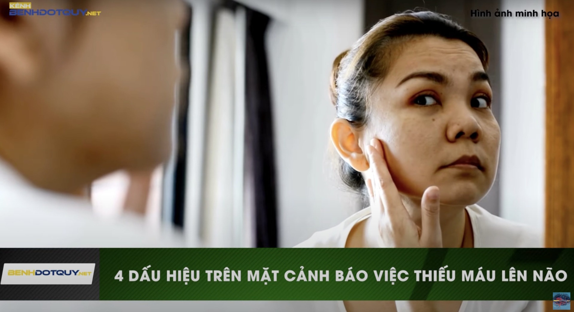 Nhận biết 4 dấu hiệu trên mặt cảnh báo thiếu máu lên não