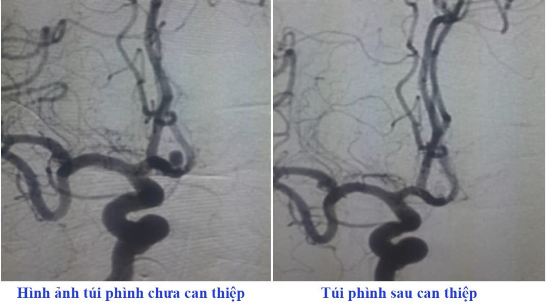 Phú Thọ: Người đàn ông đột quỵ do uống thuốc điều trị tăng huyết áp không đều