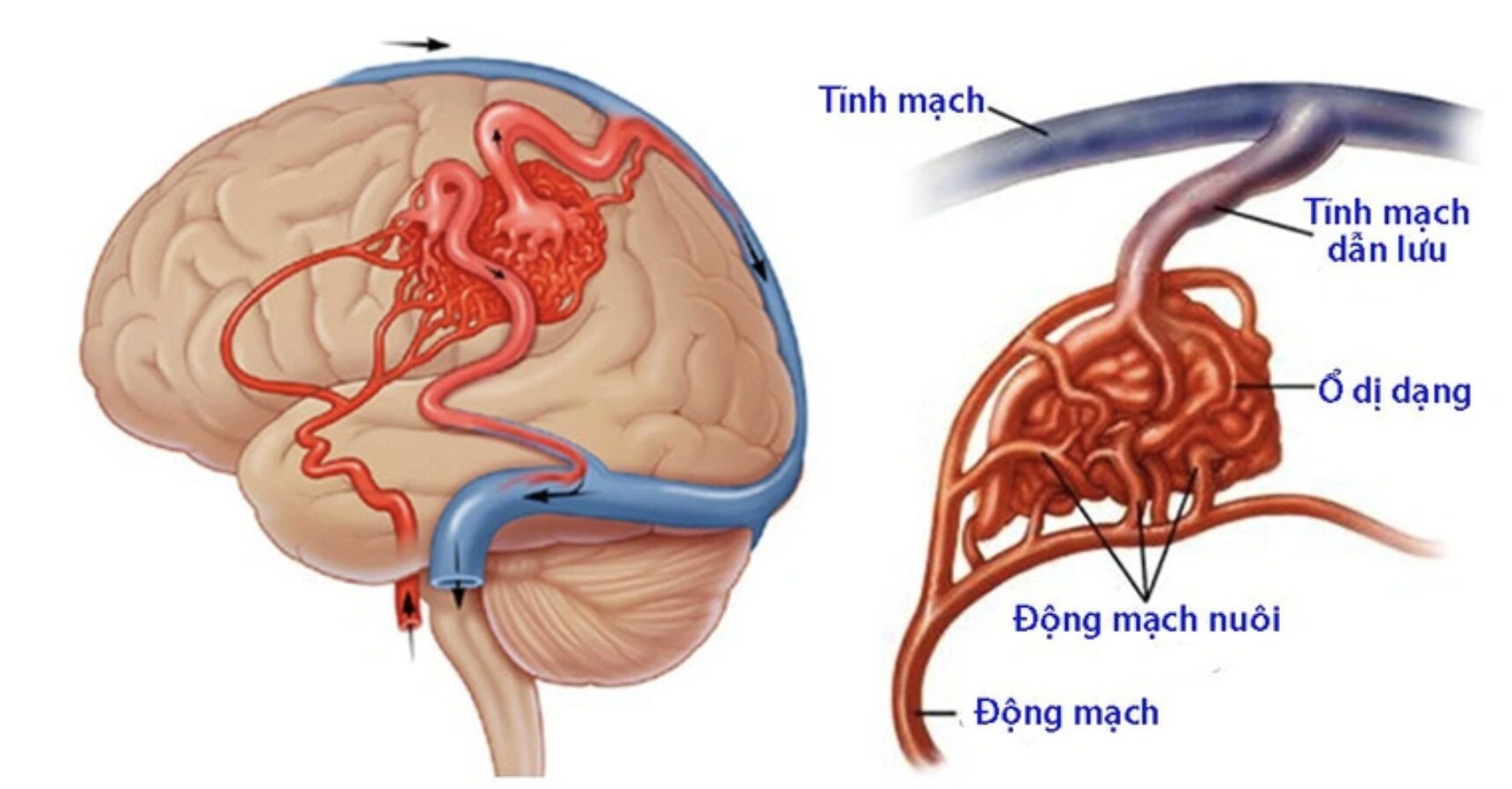 Bệnh dị dạng mạch máu thể hang có điều trị khỏi hoàn toàn không?