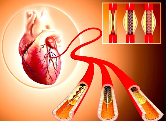 Ưu và nhược điểm của các loại stent điều trị hẹp động mạch vành phổ biến hiện nay?