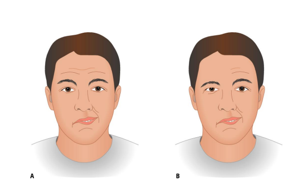 Phẫu thuật điều trị liệt mặt do chấn thương liệu có hiệu quả?