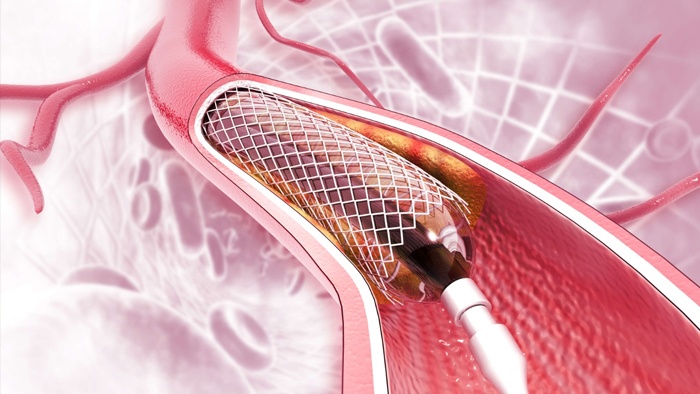 Can thiệp đặt stent động mạch cảnh trong, chi phí ra sao?