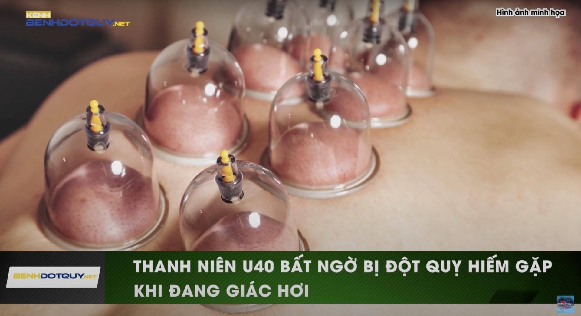 Giác hơi tại nhà, thanh niên 35 tuổi bất ngờ đột quỵ