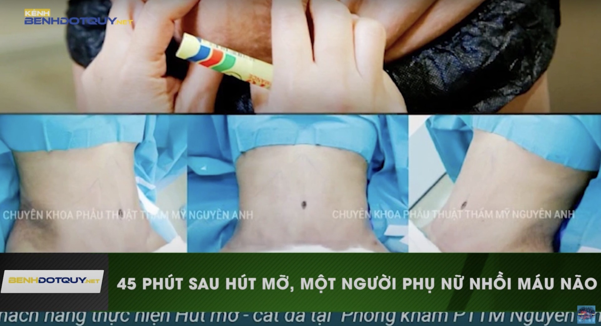 Người phụ nữ 31 tuổi nhồi máu não diện rộng sau khi thực hiện hút mỡ