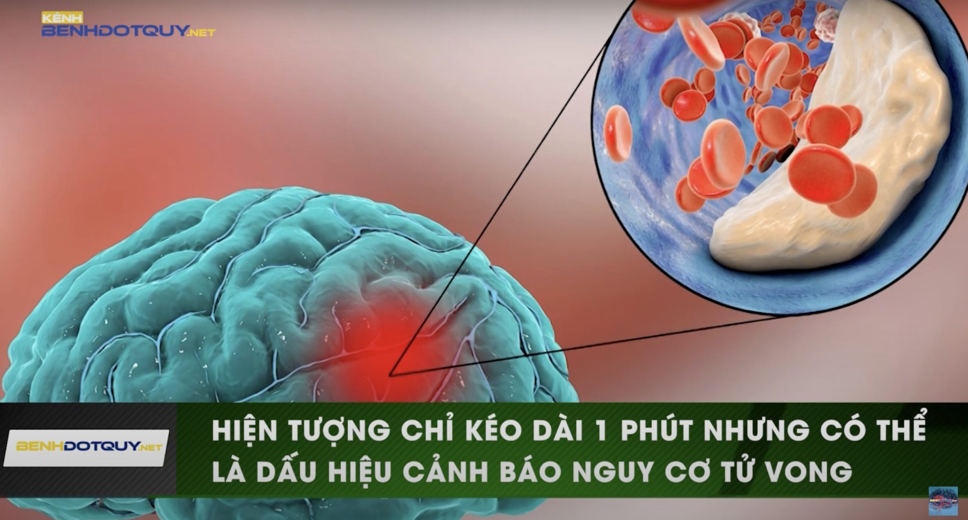 Dấu hiệu thiếu máu não thoáng qua có thể cảnh báo nguy cơ tử vong