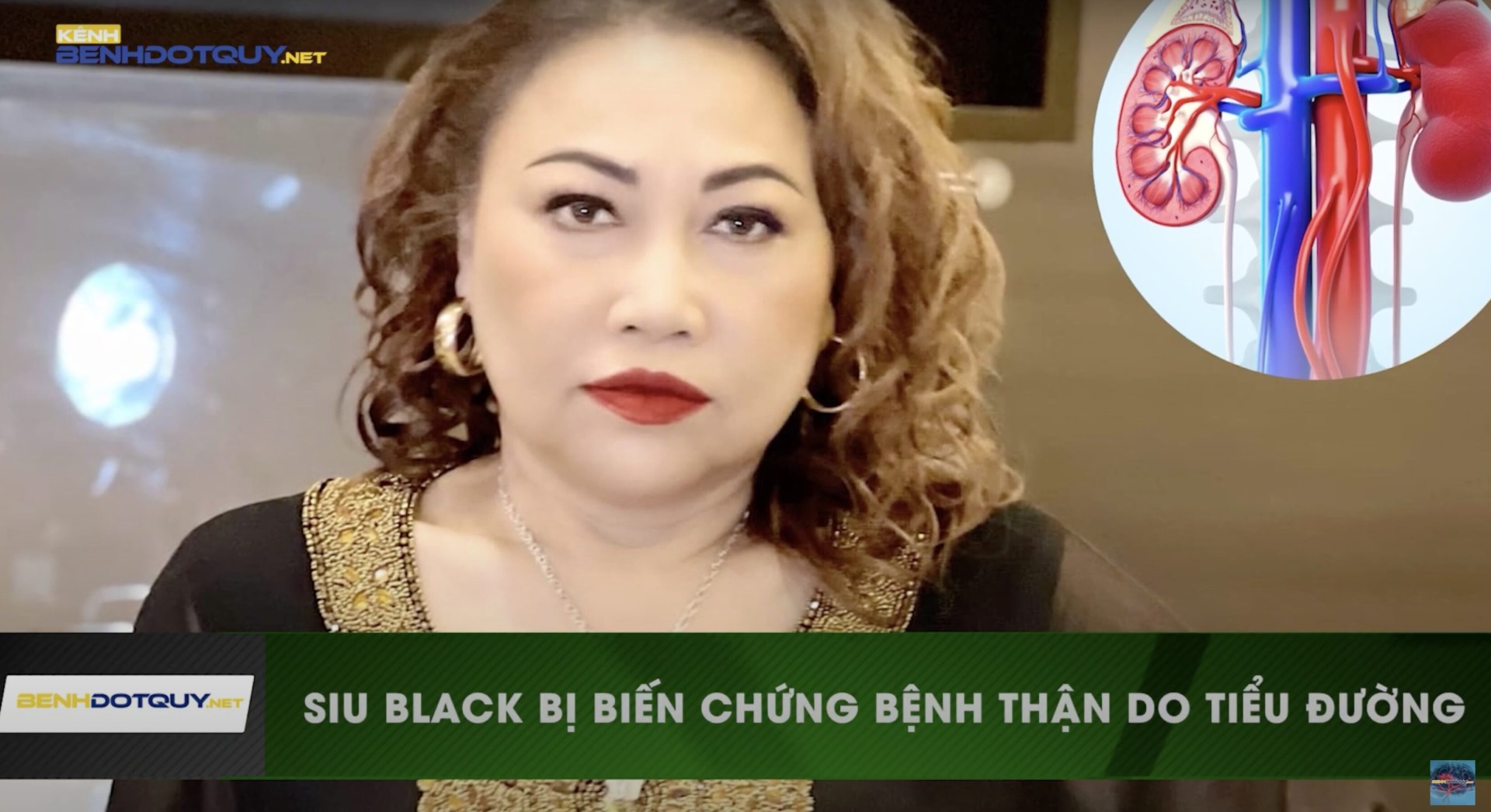 Ca sĩ Siu Black bị biến chứng bệnh thận do tiểu đường