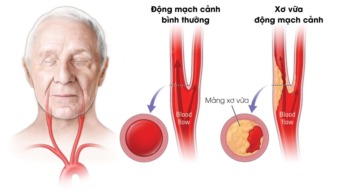 Tôi phải làm gì khi bố tôi thường xuyên bị lịm dần do tắc nghẽn 3/4 động mạch cảnh?