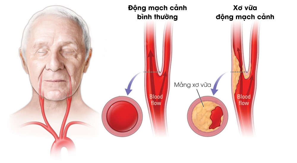 Tôi phải làm gì khi bố tôi thường xuyên bị lịm dần do tắc nghẽn 3/4 động mạch cảnh?