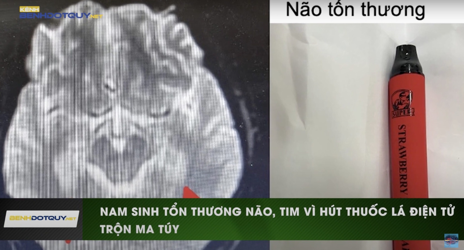 Một nam sinh Hà Nội tổn thương não, tim vì thuốc lá điện tử trộn ma túy