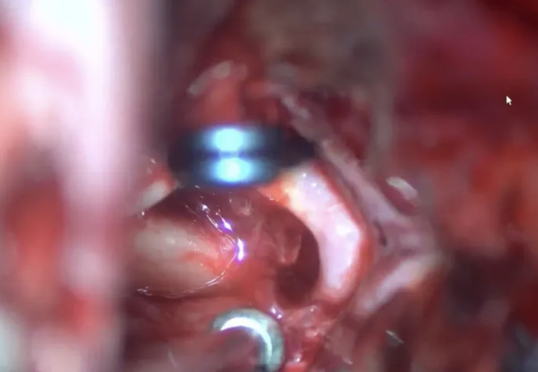 Hải Phòng: Nữ du khách đột quỵ do vỡ dị dạng mạch máu được cứu sống thành công