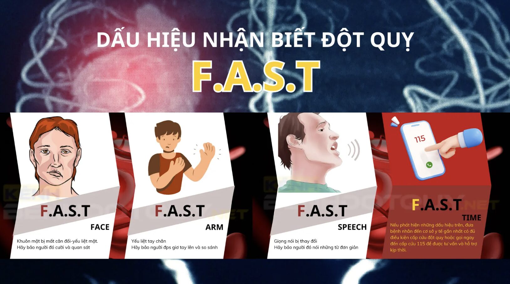Nhận biết, cấp cứu đột quỵ kịp thời qua ba dấu hiệu và yếu tố thời gian