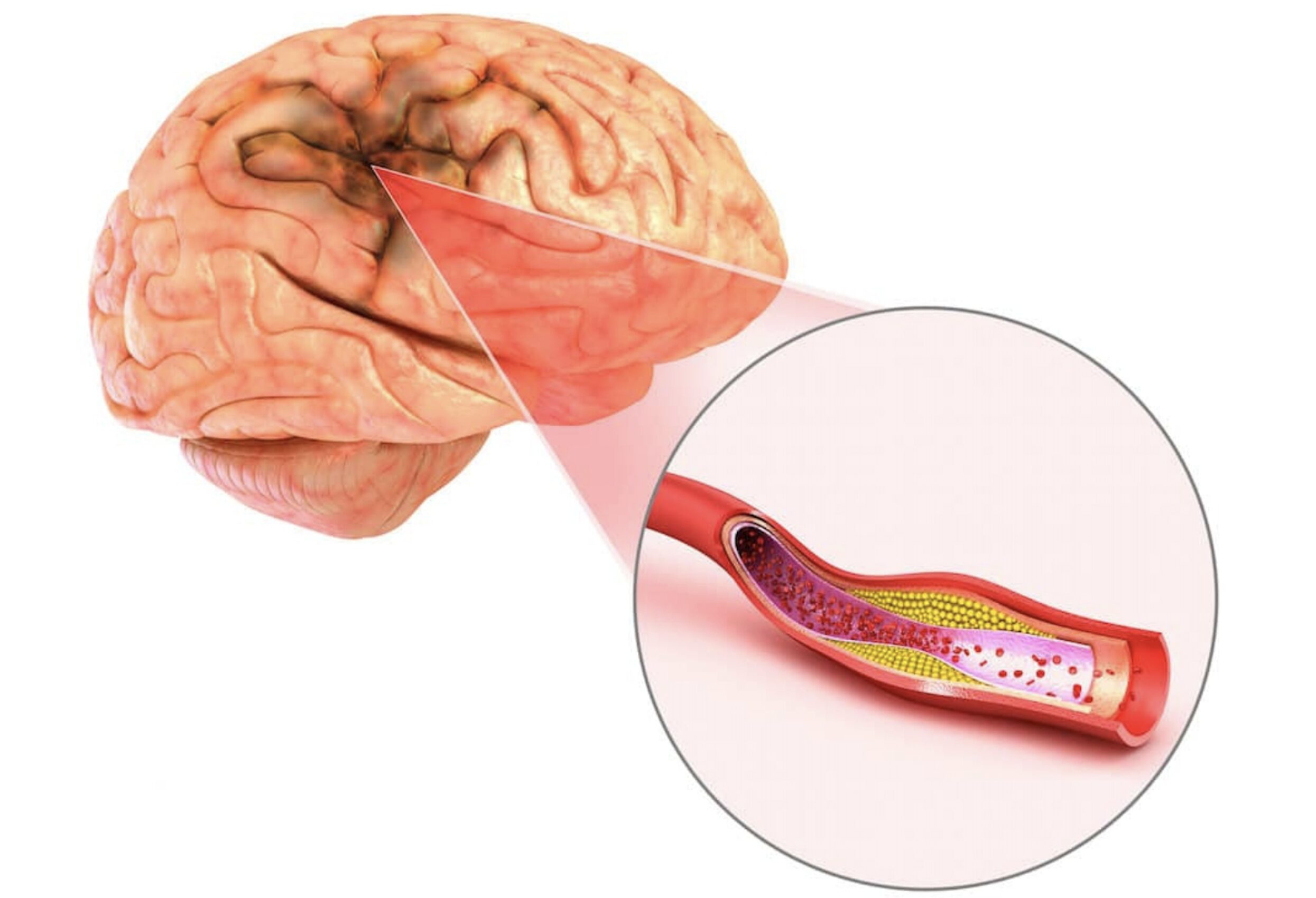 20% trường hợp có dấu hiệu thiếu máu não cục bộ thoáng qua có thể bị đột quỵ trong 90 ngày sau